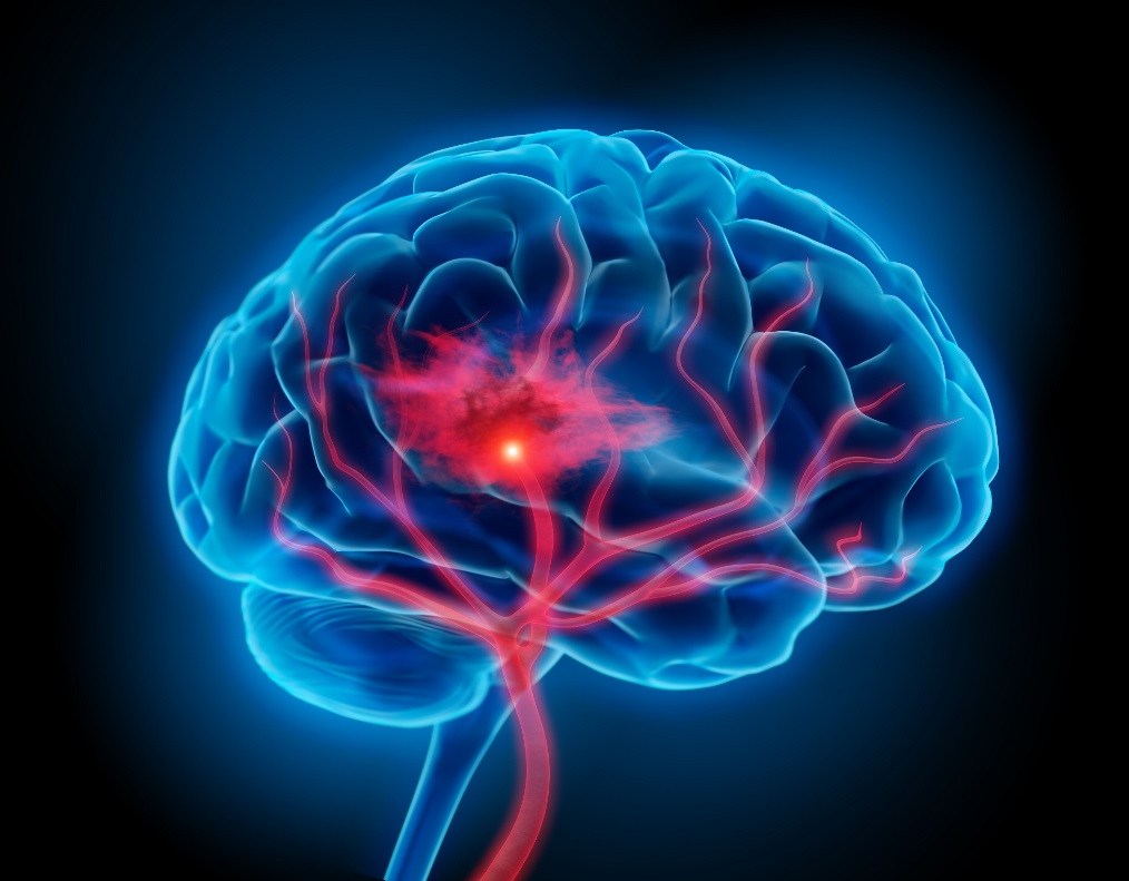 Estudo afirma que bloquear inflamação cerebral detém avanço do Alzheimer